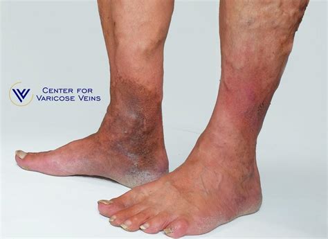 Whats The Connection Between Varicose Veins And Skin Discoloration