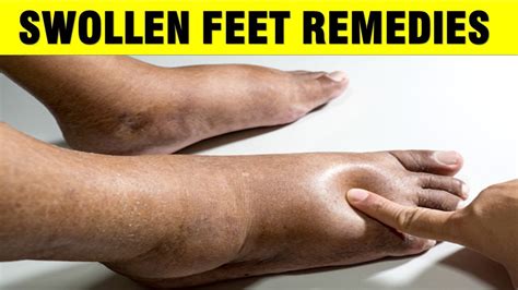 10 Home Remedies For Swollen Feet Edema Remedy Youtube