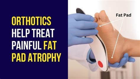 How Orthotics Help In Painful Foot Fat Pad Atrophy Treatment Youtube