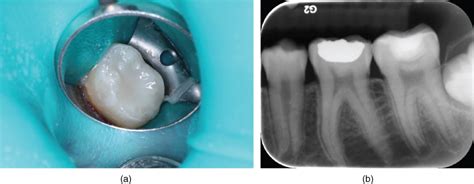 Indirect Pulp Therapy For Young Permanent Molars Pocket Dentistry