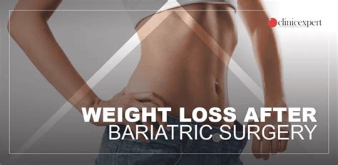 Expected Weight Loss After Bariatric Surgery Clinicexpert