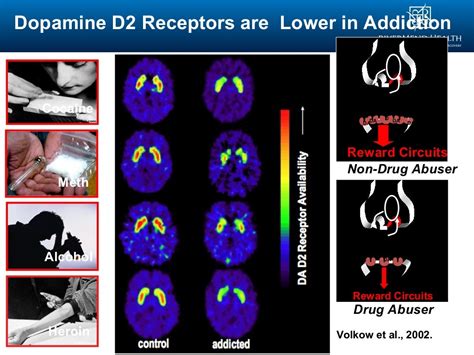 Addiction As A Brain Disease Brain Imaging In Addictions