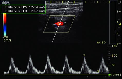 Carotid Duplex Ultrasonography In A Patient With Takayasu S Arteritis