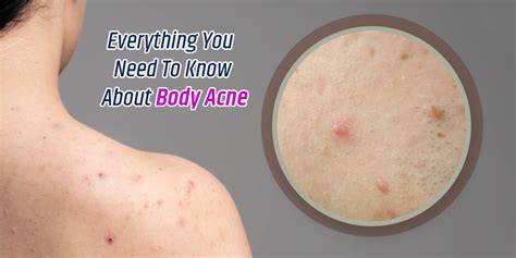 Body Acne Symptoms Causes And Treatment Onlymyhealth