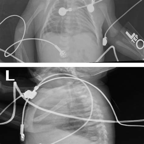 Day Of Life Frontal And Lateral Radiographs Demonstrate Lucency