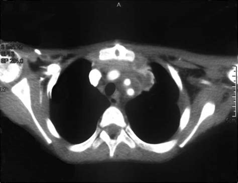 Primary Giant Mediastinal Synovial Sarcoma Of The Neck A Case Report
