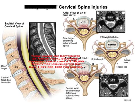 Amicus Illustration Of Amicusinjurycervicalspinediscbulgecentral