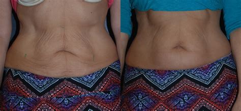 Skin Tightening Abdomen RejuvaYou Medical