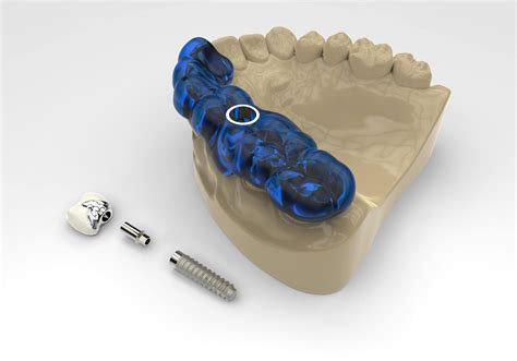 The Evolution Of Implant Surgical Guides Conescan