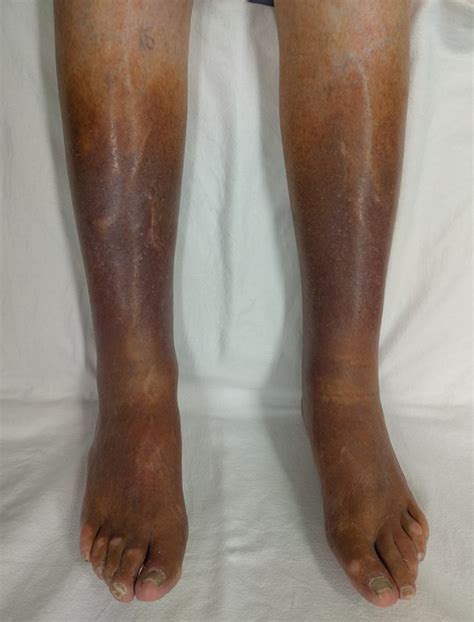 Understanding Venous Insufficiency Causes And Symptoms