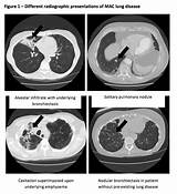 Ntm Lung Disease Treatment