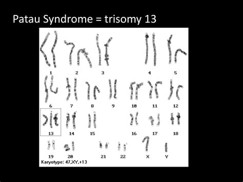 Ppt Human Chromosome Disorders Powerpoint Presentation Free Download Id2171534