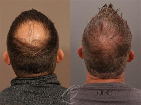 Male FUE Hair Transplant Before After Photo Gallery Rochester