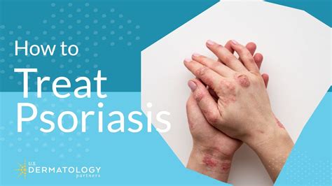 Psoriasis Treatment Explained By Dermatologist Youtube