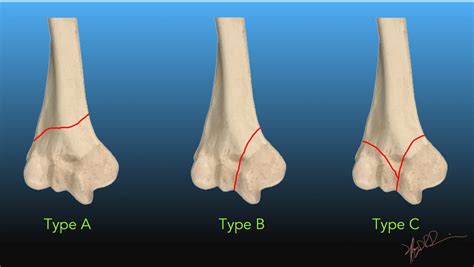 Ao Ota Classification Of Distal Humeral Fractures Uw Emergency Radiology