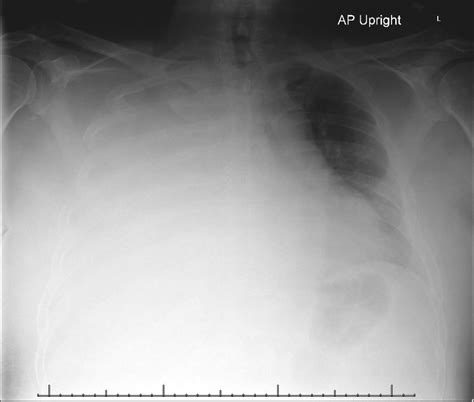 Ap Chest Radiograph Showing Right Sided Pleural Effusion The Medical