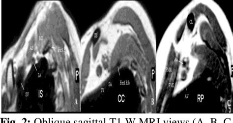 Figure 2 From A Pictorial Essay Of Mri Findings Obstetric Brachial