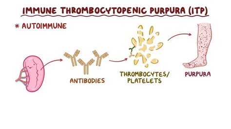 Causes Of Thrombocytopenia Purpura Medizzy