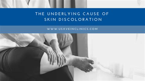 The Underlying Cause Of Skin Discoloration Usa Vein Clinics