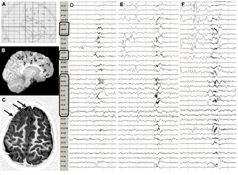 Stereotactic Scheme Post Implantation And Preoperative Mri