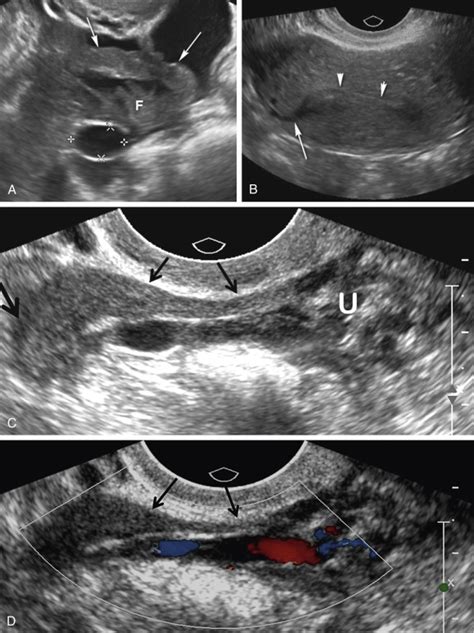 Tushy Method Blocked Fallopian Tubes Transvaginal Ultrasound Trouble
