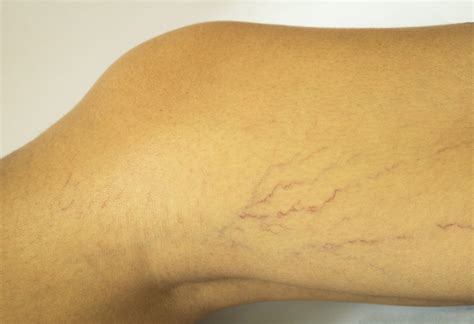 Varicose Veins During Pregnancy Treatment Beauty And