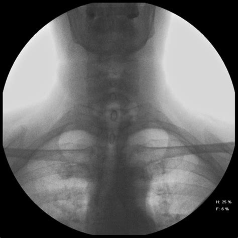 Zenker Diverticulum Image Radiopaedia Org