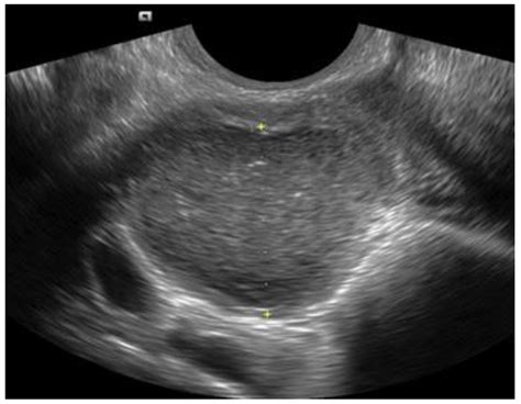 Diagnostics Free Full Text Transvaginal Ultrasound In The Diagnosis