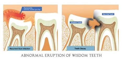 30 Gum Infection Wisdom Teeth Background Teeth Walls Collection For