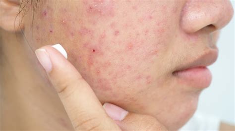 What Is Aklief And How Does It Compare To Tretinoin For Acne