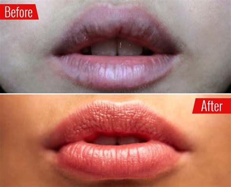 How To Lighten Dark Upper Lips With Expert Remedies How To Lighten