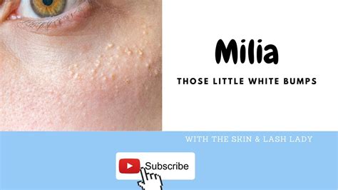Milia Milk Bumps And Why Your Skin Needs To Drink Water Youtube
