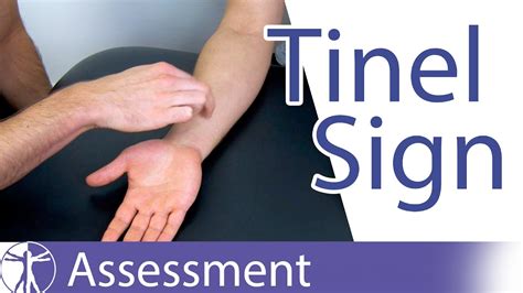 Tinel Sign Wrist Carpal Tunnel Syndrome Diagnosis Youtube