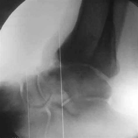 Intraoperative Fluoroscopic View After Osteophyte Resection And Graft