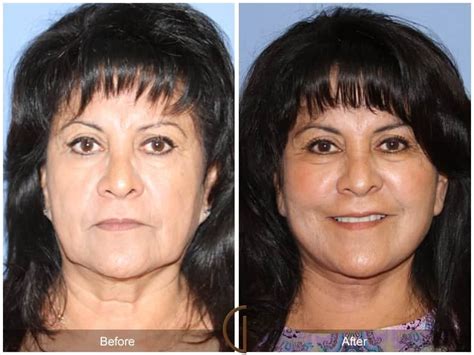 Facial Fat Grafting San Diego Ca 55 Before And After Photos