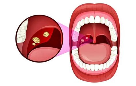 10 Causes And Symptoms Of Tonsillitis