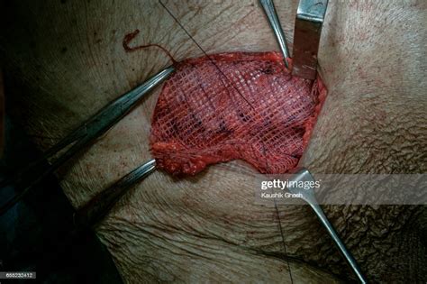Implant Of Polypropylene Mesh After Inguinal Hernia Repair High Res