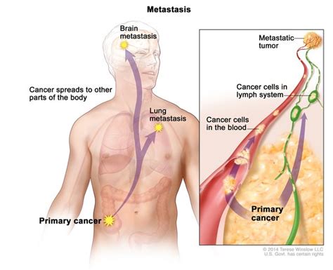 Lung Cancer Medlineplus Genetics