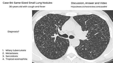 Case Same Sized Small Lung Nodules