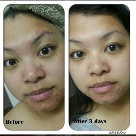 Since tea tree oil can cause skin irritation, dilute it well. The Body Shop Tea Tree Oil reviews, photos, ingredients ...