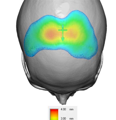 Coronal Dip Custom Skull Implant Dimensions Dr Barry Eppley