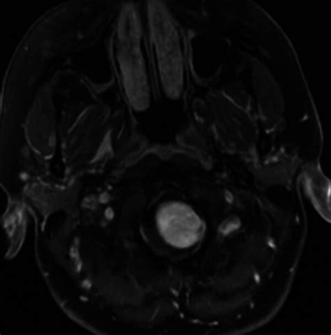 Preoperative Axial T1 Weighted Magnetic Resonance Imaging With Contrast