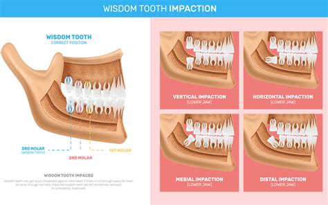 Normal And Wisdom Tooth Removal Shifa Dental Clinic Quality And