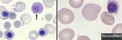 Nucleated Red Blood Cells Aka Normoblasts Or Erythroblasts Grepmed