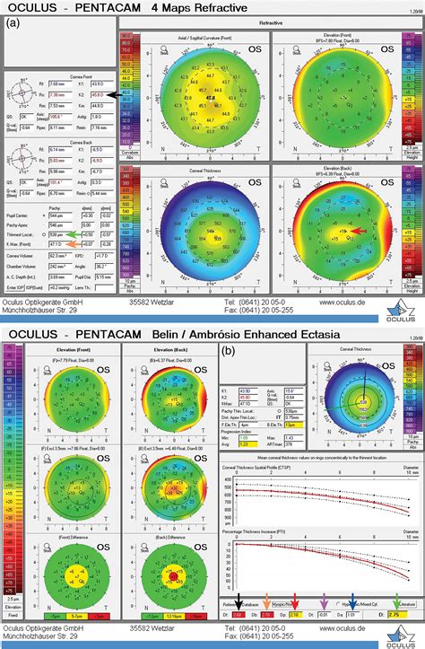 Advanced Anterior Segment Imaging In Keratoconus A Review Gokul