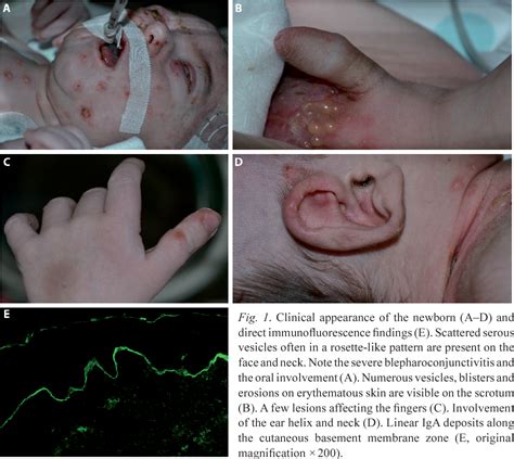 Figure 1 From A Case Of Neonatal Linear Iga Bullous Dermatosis With