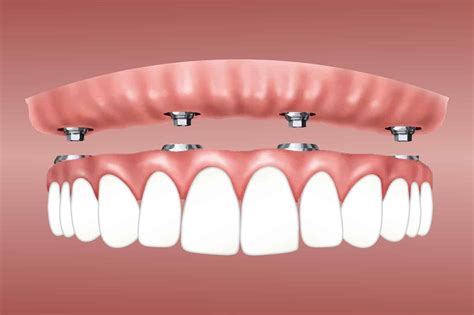 What All You Should Know About All On 4 Dental Implants Idea Express