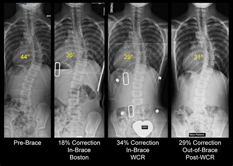 Types Of Scoliosis Bracing Joy Of Therapy Specializes In Scoliosis