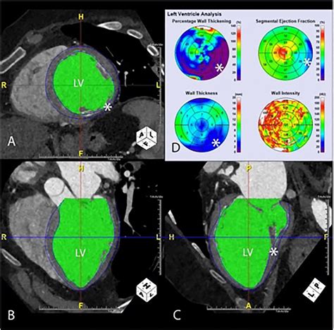Multiphase Cardiac Ct Showing Automated Segmentation Of The Left