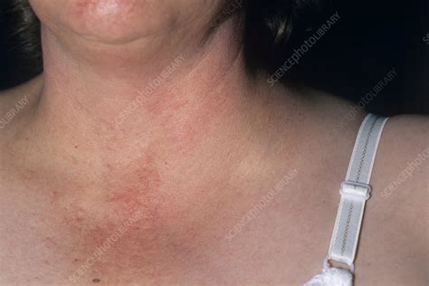 Swollen lymph nodes are also known as lymphadenitis, lymphadenopathy, swollen nodes, or swollen glands. Swollen lymph node - Stock Image M131/0633 - Science Photo ...